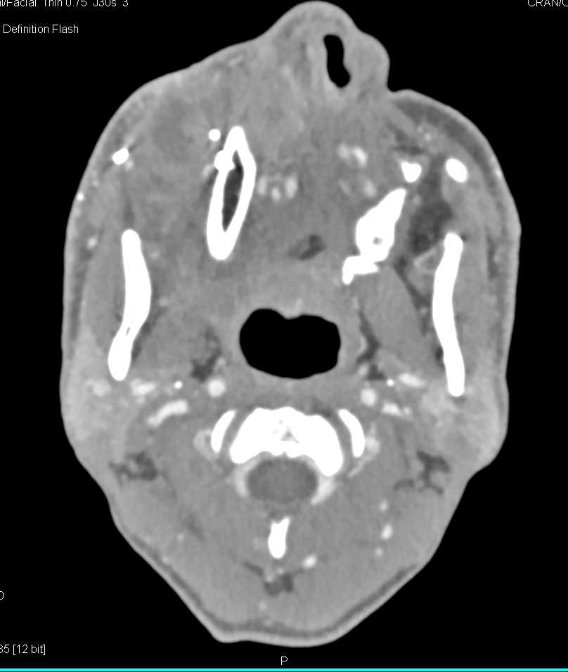 Invasive Carcinoma Sinuses - CTisus CT Scan