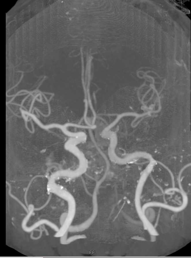 Carotid Artery Disease - CTisus CT Scan