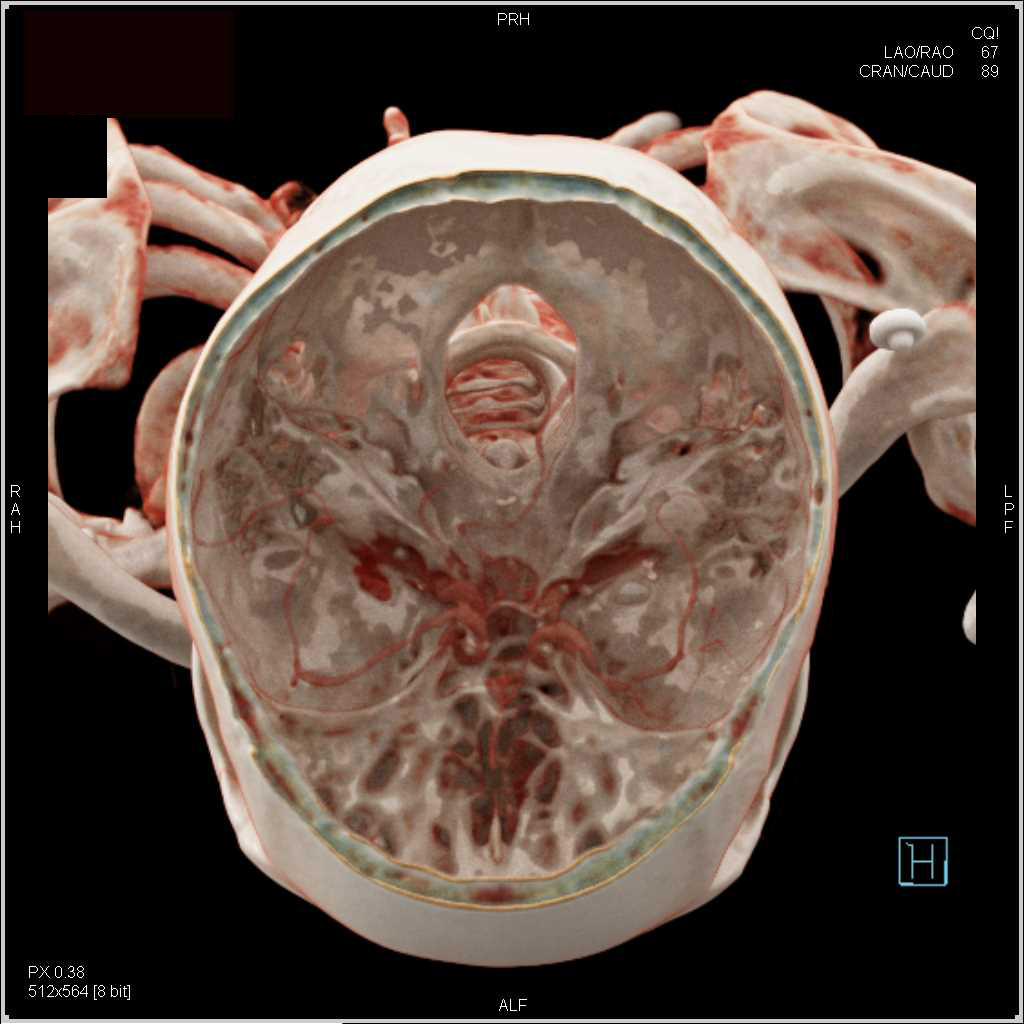 Normal Cranial Anatomy - CTisus CT Scan