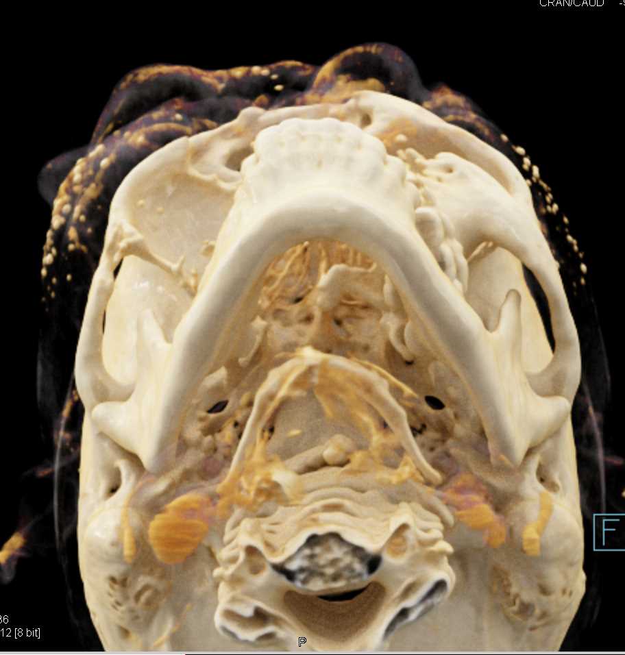 Aggressive Tumor Invading the Skull with Soft Tissue Mass - CTisus CT Scan