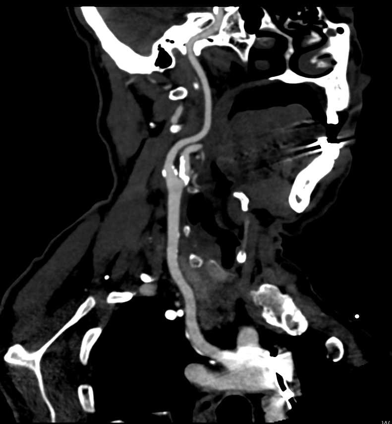 Carotid Artery Disease - CTisus CT Scan