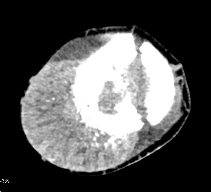 Brain tumor with bleed - CTisus CT Scan