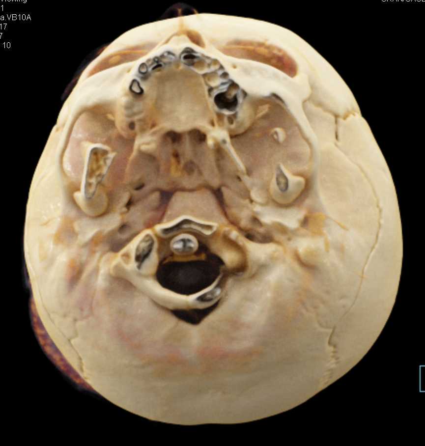 Cranial Tumor with Bony Involvement and Bleeding with Cinematic Rendering - CTisus CT Scan