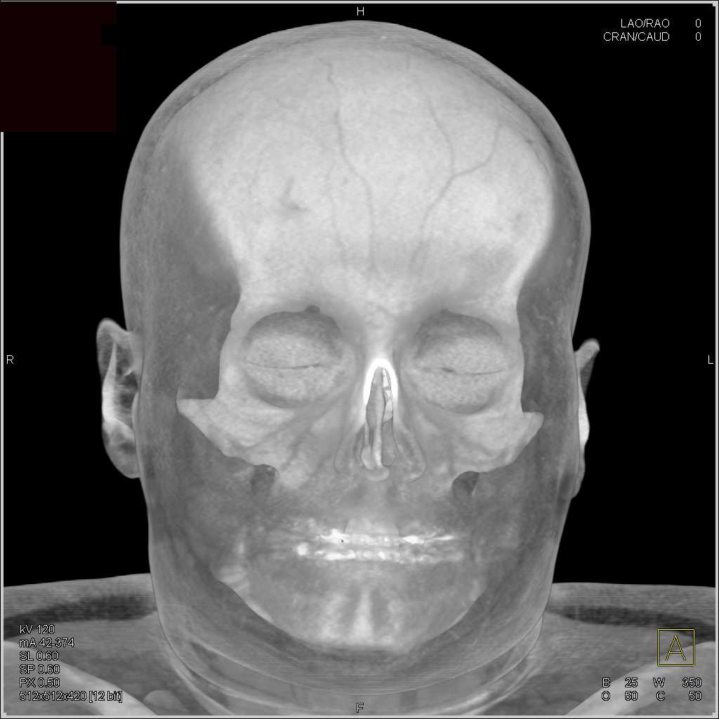 Cranial 3D CT - CTisus CT Scan