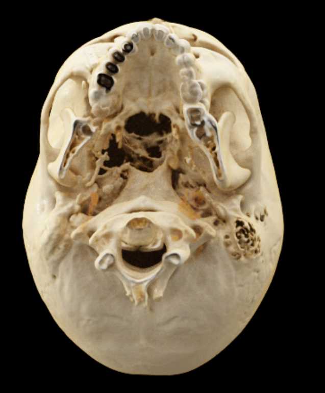 Cinematic Rendering of the Skull - CTisus CT Scan