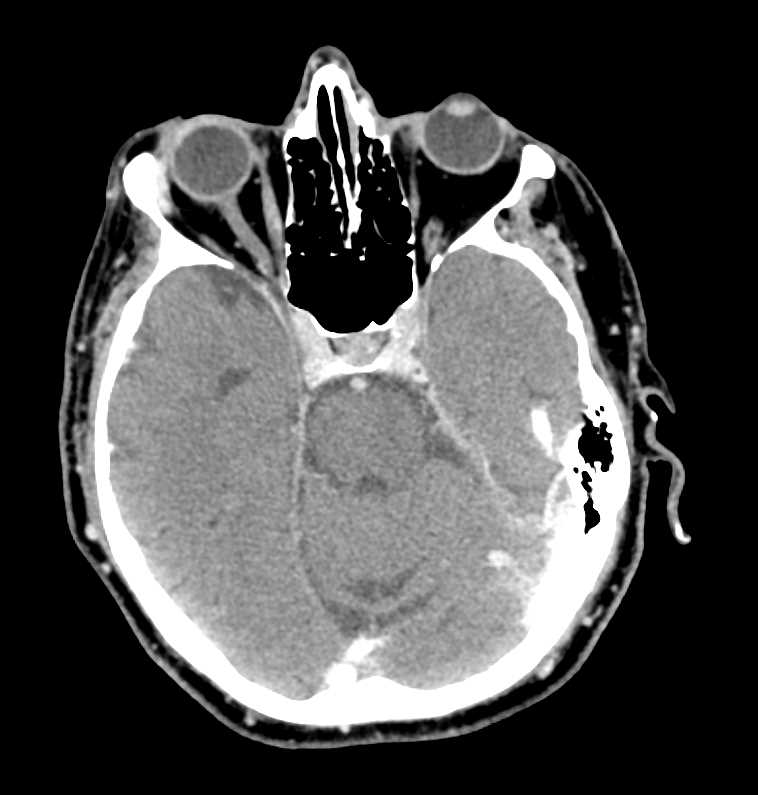 Mandibular Reconstruction - CTisus CT Scan