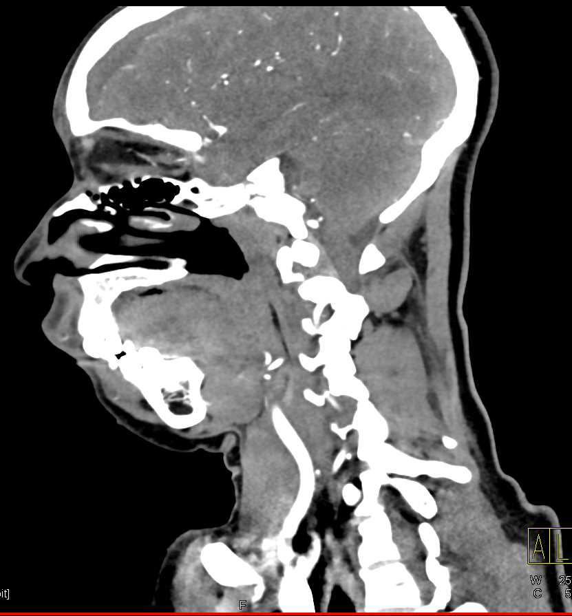 Trauma with Soft Tissue Hematoma - CTisus CT Scan