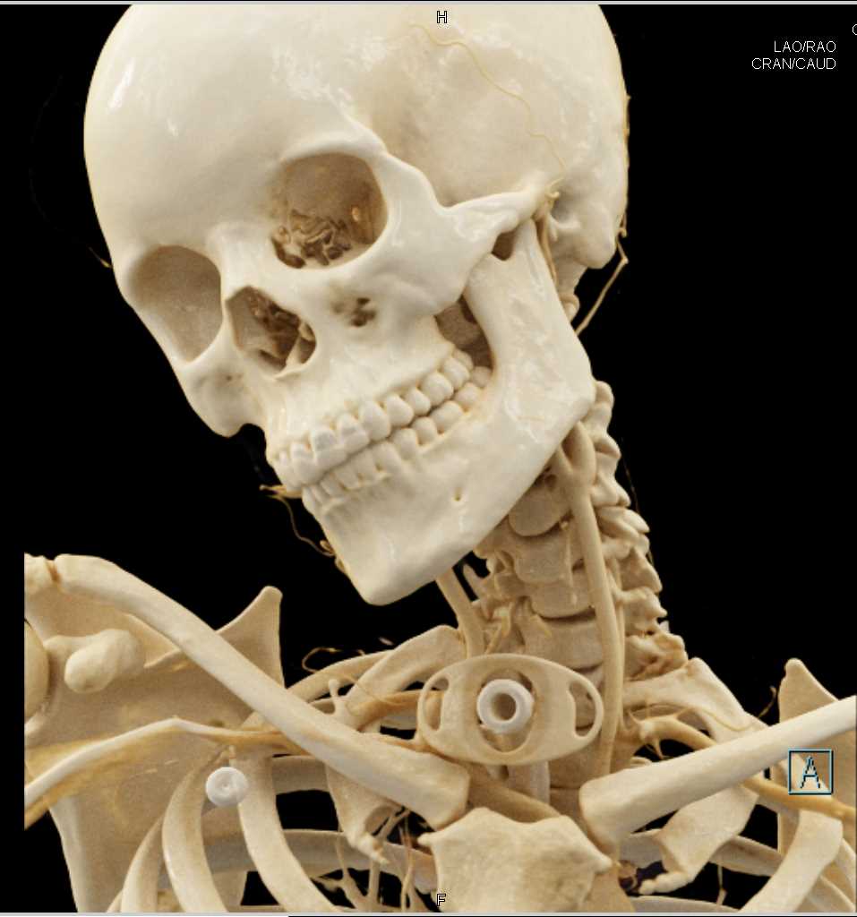 Brain Trauma with Soft Tissue Hematoma - CTisus CT Scan