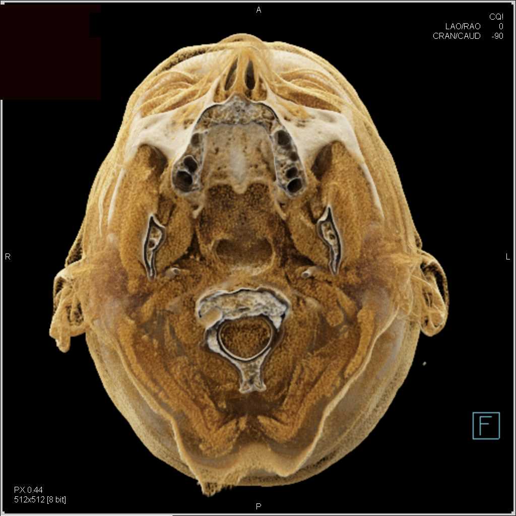 Cinematic Rendering of the Skull - CTisus CT Scan