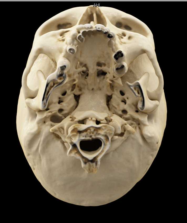 Cinematic Rendering of the Skull and C-Spine - CTisus CT Scan