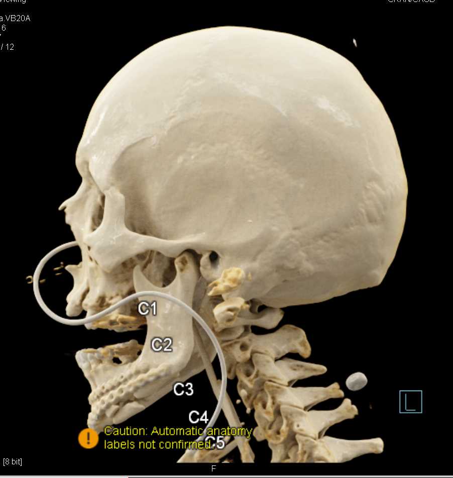 Cinematic Rendering of the Skull - CTisus CT Scan