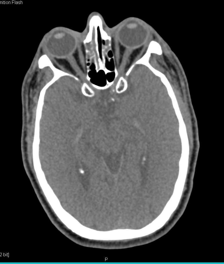 Severe Sinusitis - CTisus CT Scan