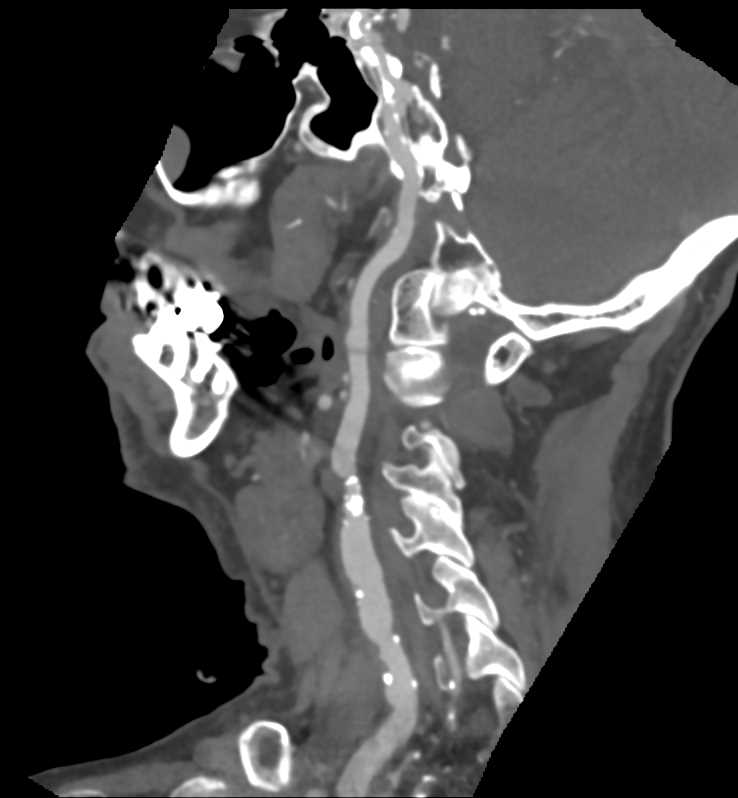 Extensive Carotid Artery Disease - CTisus CT Scan