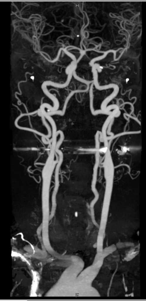 Normal Carotid Circulation - CTisus CT Scan