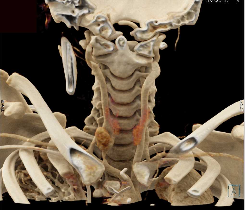 Pseudoaneurysm Carotid Artery - CTisus CT Scan