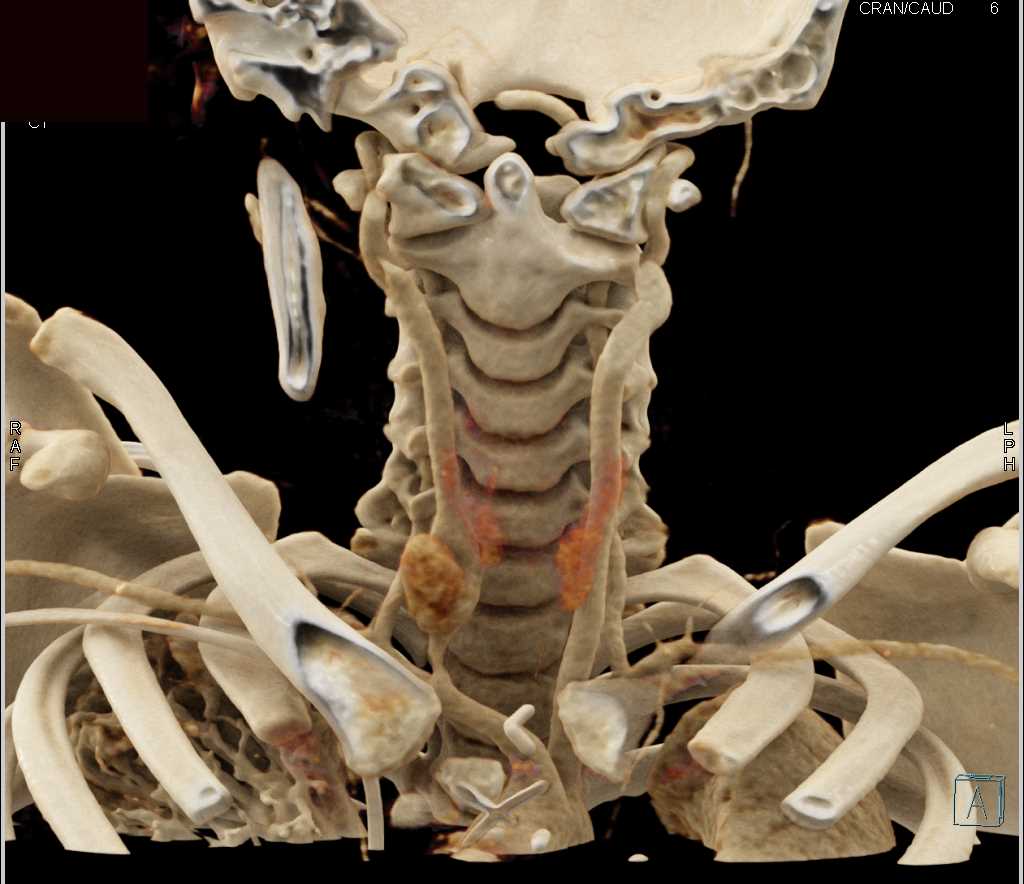 Pseudoaneurysm Carotid Artery - CTisus CT Scan