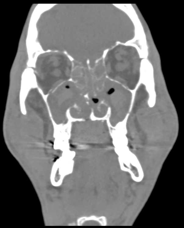 Repair of Orbital Fractures - CTisus CT Scan