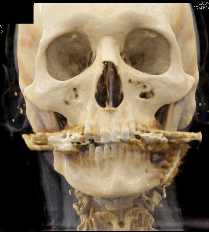 Post Fascial Trauma Repair - CTisus CT Scan