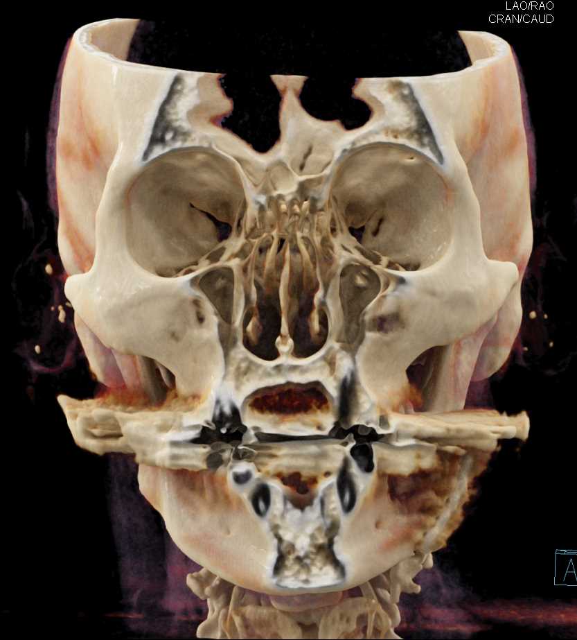 Post Fascial Trauma Repair - CTisus CT Scan