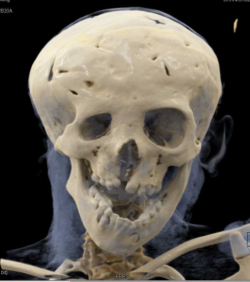 Craniofascial Deformity - CTisus CT Scan