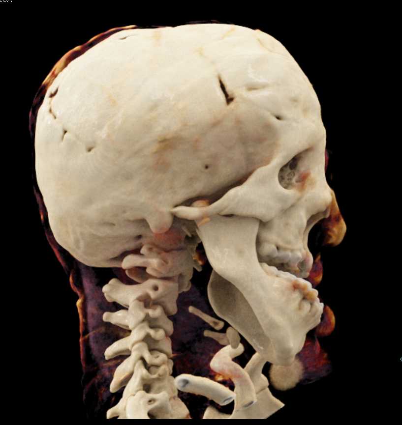 Craniofacial Deformity - CTisus CT Scan