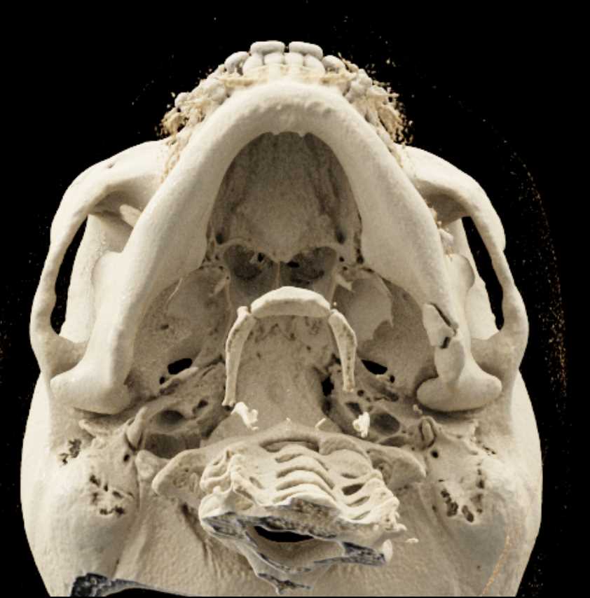 Mandibular Fracture with Cinematic Rendering - CTisus CT Scan