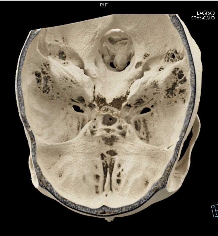 Mandibular Fracture with Cinematic Rendering - CTisus CT Scan