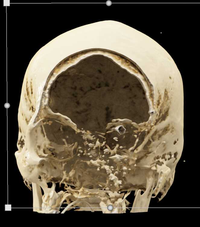 Orbital Trauma - CTisus CT Scan