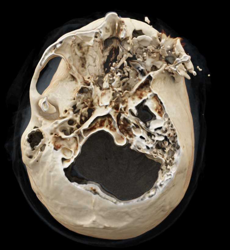 Orbital Trauma - CTisus CT Scan
