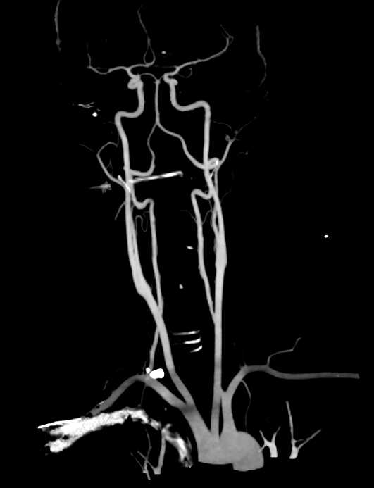 CTA of the Carotid Arteries - CTisus CT Scan