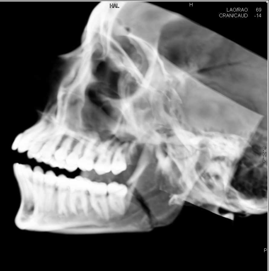 Left Mandible Fracture - CTisus CT Scan