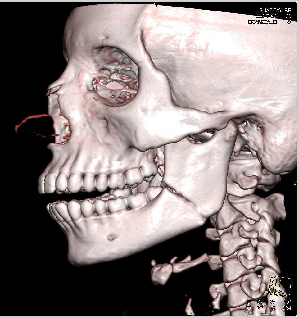 Left Mandible Fracture - CTisus CT Scan