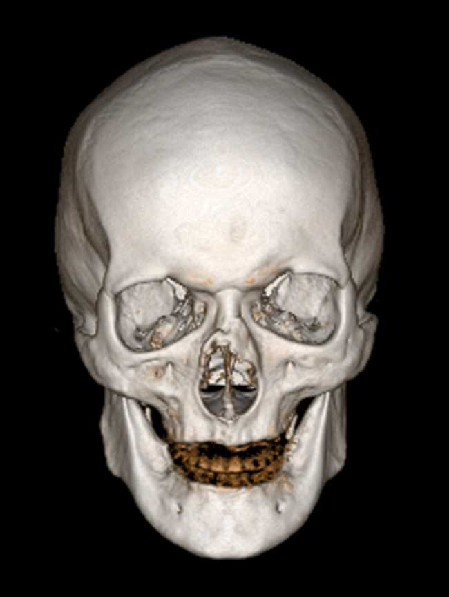 Volume Rendering of the Skull - CTisus CT Scan