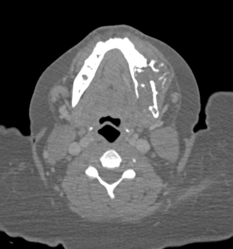 Ameloblastoma of the Mandible - CTisus CT Scan