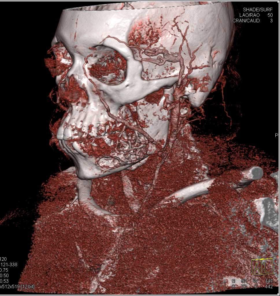 Ameloblastoma of the Mandible - CTisus CT Scan