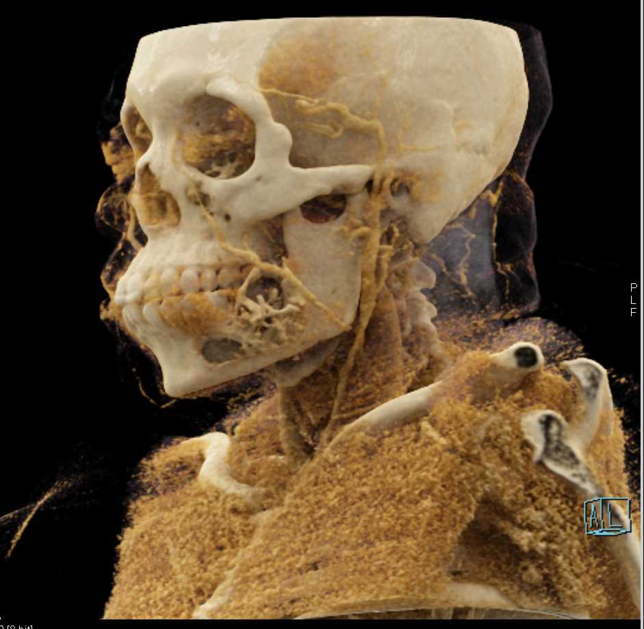 Ameloblastoma of the Mandible with Cinematic Rendering - CTisus CT Scan