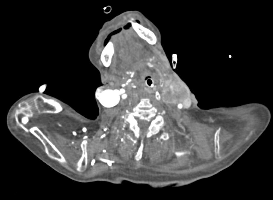 Head and Neck Cancer with Vascular Involvement - CTisus CT Scan