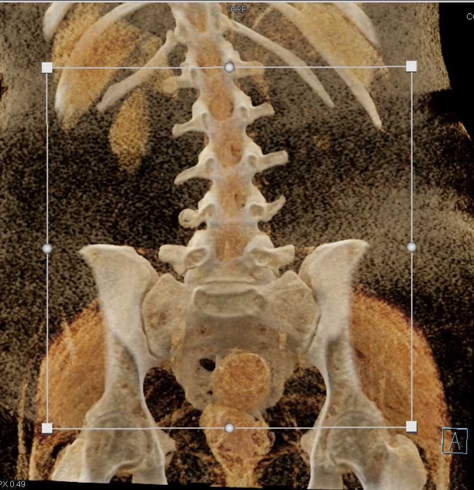 Spinal Cord with Cinematic Rendering - CTisus CT Scan