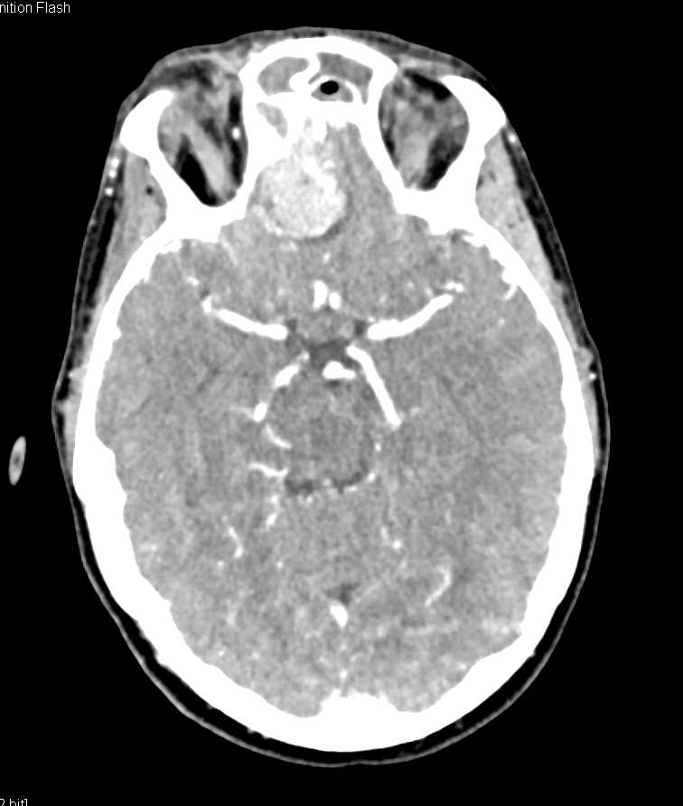 Aggressive Tumor Involves Frontal Sinuses - CTisus CT Scan