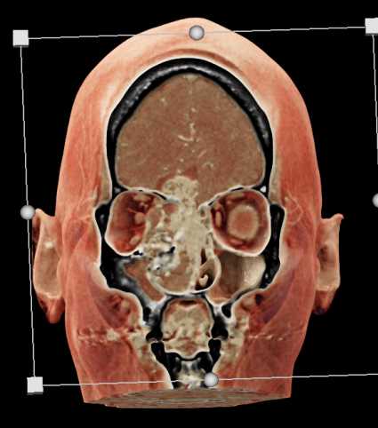 Aggressive Tumor Involves Frontal Sinuses - CTisus CT Scan