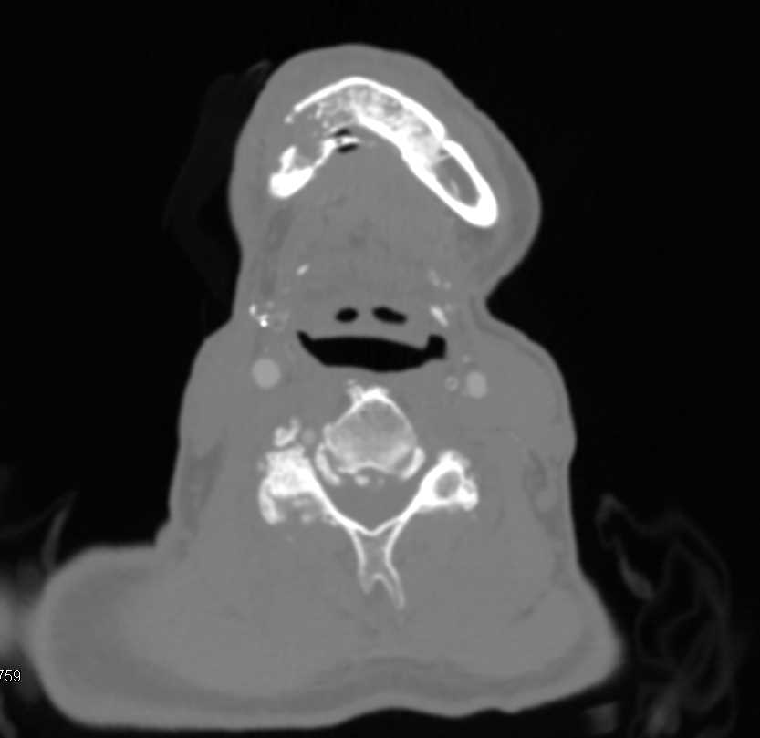 Mandible Fracture - CTisus CT Scan