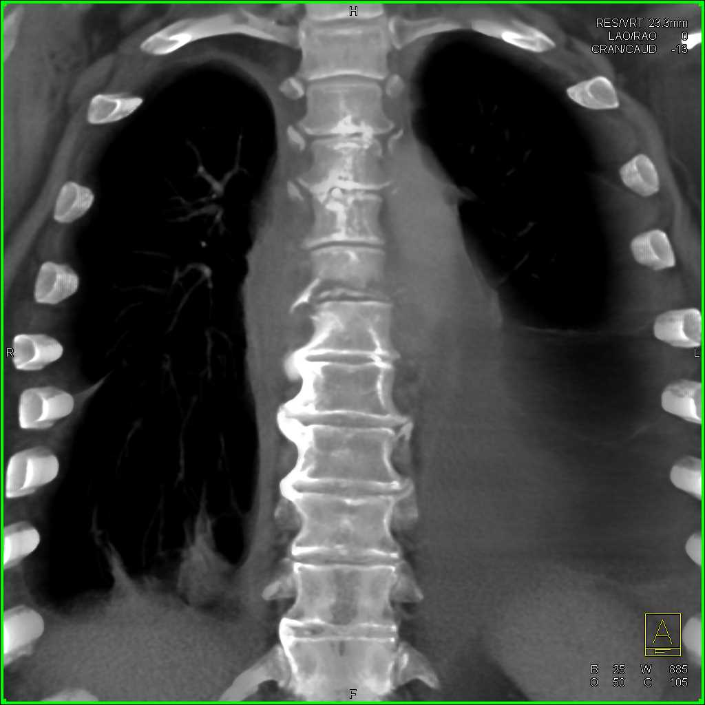 Osteomyelitis and Paraspinal Abscess T-Spine - CTisus CT Scan