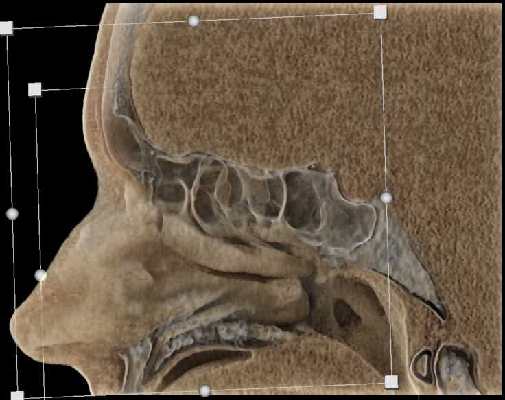 Sinuses in 3D - CTisus CT Scan