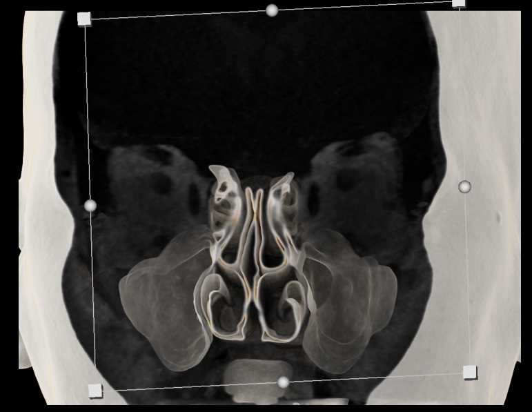 Sinuses in 3D - CTisus CT Scan