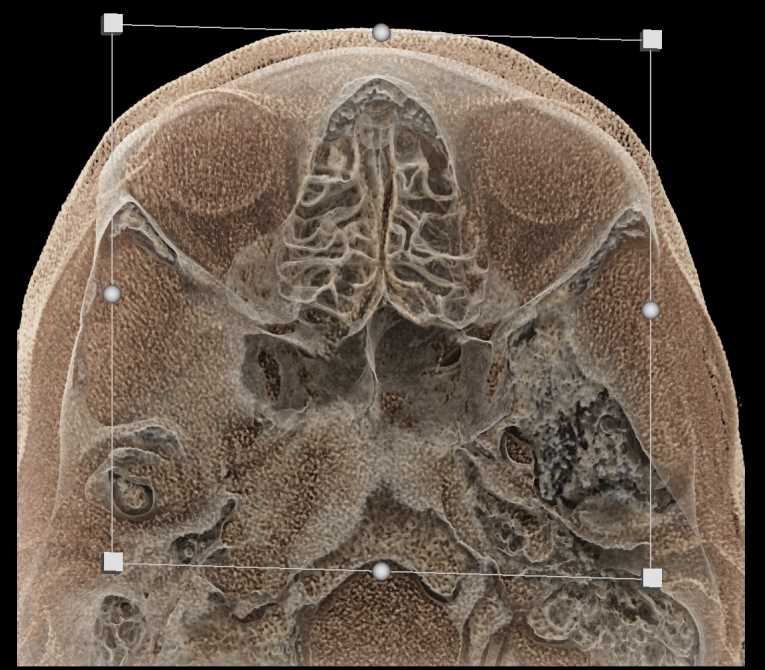 Multiple Sinus 3D Maps - CTisus CT Scan