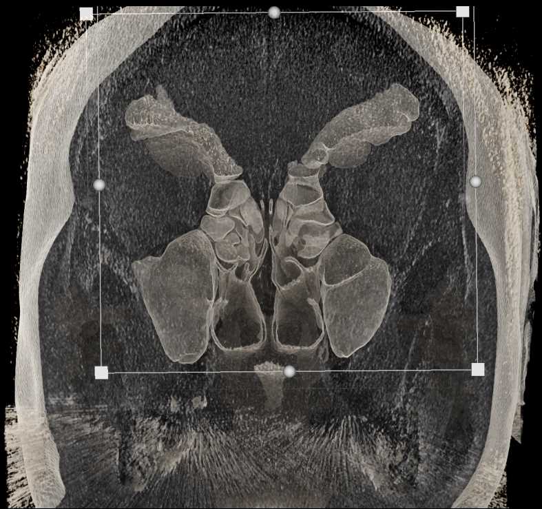 Multiple Sinus 3D Maps - CTisus CT Scan