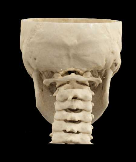 Orbital Fractures - CTisus CT Scan