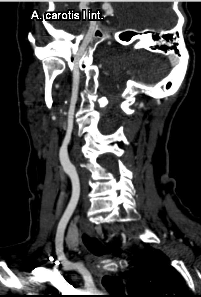Carotid Artery Plaque - CTisus CT Scan