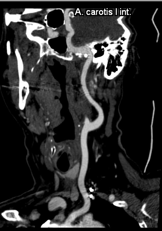 Carotid Artery Plaque - CTisus CT Scan