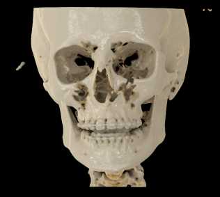 Orbital Floor Fracture on the Left - CTisus CT Scan